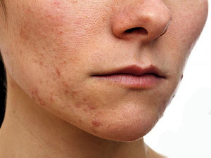 Eczema breakout on face