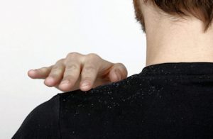 Man with dandruff falling on to shoulders