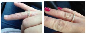 Dermatitis on hand and after picture of clear skin