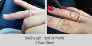 Before and after of Dermatitis on hands