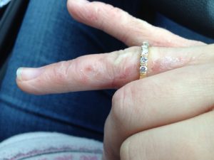 close up of Dermatitis on Hands